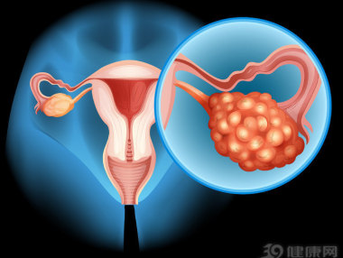 70%的卵巢癌确诊时就是晚期！三个预防要点，没多少人愿意做